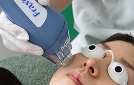 フラクショナルレーザー