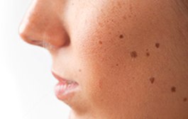 ほくろ治療
