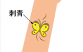 広範囲のタトゥー(刺青)除去の流れ 1