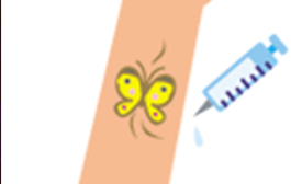 広範囲のタトゥー(刺青)除去の流れ 3