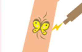 広範囲のタトゥー(刺青)除去の流れ 4